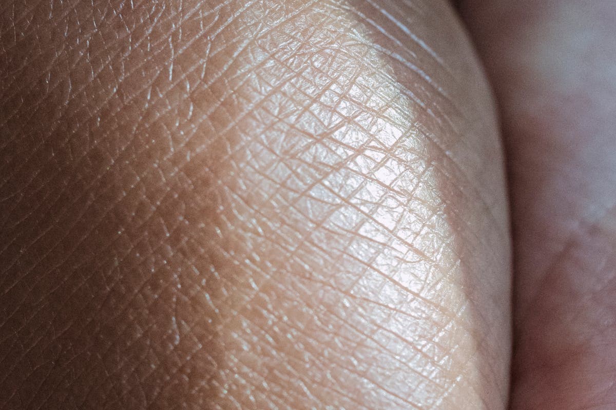 Urticaria y picor en verano: antihistamínicos y cremas